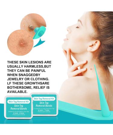 Standard Skin Tag Tool Kit Quick and Painless Solution for Medium to Small Skin Tags/Complete Skin Tag Tool Kit for Fast Results (2mm-5mm) - Buy Online on GoSupps.com