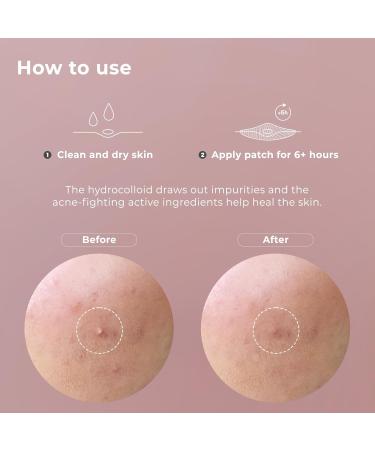 OMMA Pimple Stickers - Hydrocolloid Acne Treatment | 72 Korean Zit Patches with Salicylic Acid for Spot Treatment & Whitehead Extraction - Buy Online on GoSupps.com