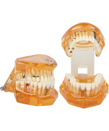 Dpofirs Orange Dental Model - Removable Teaching Tool for Dental Programs Adult Tooth Demonstration & Dental Implants - Buy Online on GoSupps.com