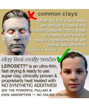 LEROSETT Spot Treatment & Clay Mask - Swedish Clay for Acne Prone Skin - Minimize Pores, Pimples, Blackheads, Detox & Blemishes - All-Natural, Vegan - 3 oz - Buy Online on GoSupps.com