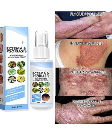 Title: BEESO Melllop Herbal Psoriasis Relief Spray - 5pcs Pack for Itchy Skin Rejuvenation - Buy Online on GoSupps.com