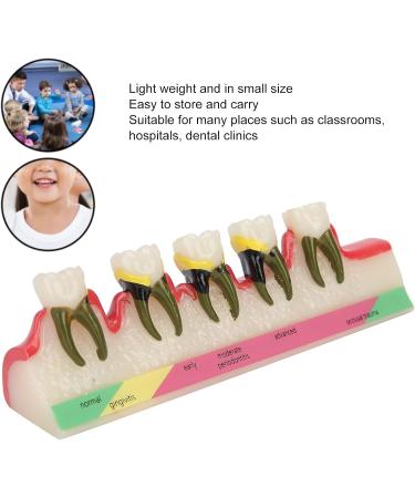 Dental Periodontitis Model | Periodontal Development Study Tool for Dental Research & Learning - Buy Online on GoSupps.com