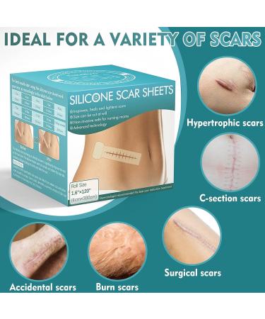 Professional Silicone Scar Sheets Roll 1.6x120 - Effective for C-Section, Surgery, Burns, Keloids - 3M Silicone Tape for Old & New Scars - Buy Online on GoSupps.com