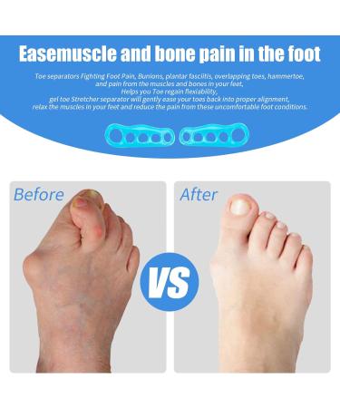 Gel Toe Separators & Stretchers for Overlapping Toes & Hallux Valgus Relief - Large Size (10 Count) - Buy Online on GoSupps.com