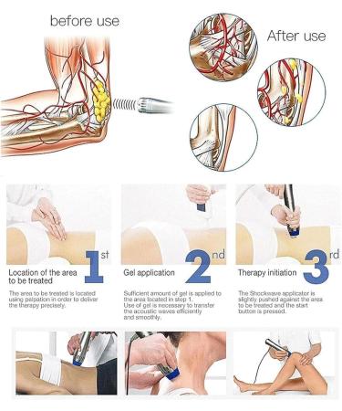 ZIXIAOS ED Shock Wave Therapy Device - Professional Pain Relief & ED Treatment Massage Device for Muscle Pain Relief - Buy Online on GoSupps.com