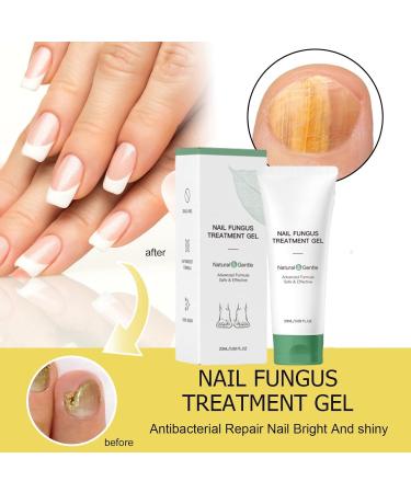 Nail Fungus Treatment Gel Fungal Cream for Brittle Thin Damaged Nails Exploding and Growth Cuticle Repair MultiPurpose Repair1pc - Buy Online on GoSupps.com