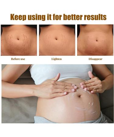Stretch Mark Cream Prevention Stretch Mark Cream Skin Hydration Whitening Specialized Care for Stretch Marks Dry Skin and Irregular Skin Fragrance Free - Buy Online on GoSupps.com