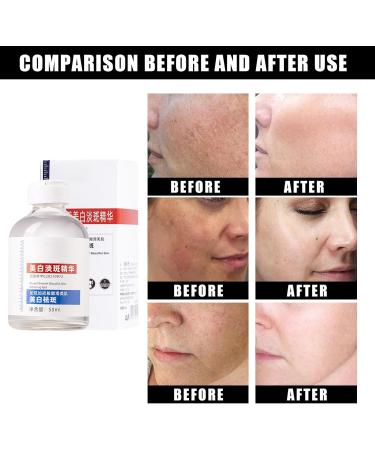 Aobenz Spot Remover for Face Dark Spots Remover Aobenz Dark Spot Correcting Serum Brightening Serum Dark Spot Remover for Face Freckle Remover Dark Spot Correcting Glow Serum - Buy Online on GoSupps.com