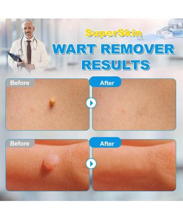 Fast Action Liquid Wart Gel - Maximum Strength Salicylic Acid Treatment for Warts Corns and Calluses - Fast-Acting Freeze Off Solution for All Wart Types - Buy Online on GoSupps.com