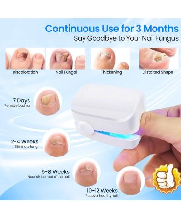 Anti Fungal Laser Device Nail Fungus Treatment Device Nail Fungus Clean Laser Equipment Light Finger Toe Nail Fungus Remover Laser-Device Nail Cleaning Equipment for Hand Toenail Infections - Buy Online on GoSupps.com