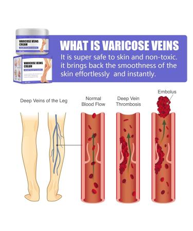 Vein Care Fading Cream 30g - Spider & Varicose Veins Treatment | Improve Leg Appearance & Circulation - 3 Pack - Buy Online on GoSupps.com