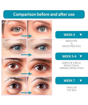 LANBENA Anti-Aging Eye Cream with Hyaluronic Acid - Reduce Wrinkles Fine Lines Dark Circles & Puffiness | International Shipping Available - Buy Online on GoSupps.com