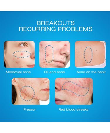  MagiSel Facial cream for acne-prone skin plant-based anti-blemish cream 20g moisturizing face cream hydrates and leaves skin feeling smooth gentle formula - Buy Online on GoSupps.com