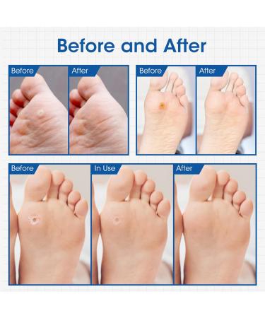Foot Corn Remover Pads - 24 Pcs Corn Removal Plasters for Feet & Toe - Wart Remover Patch for Foot Care - Ideal for Corn Relief - Buy Online on GoSupps.com