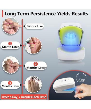 Nail Fungus Laser Treatment Device - Home Treatment for Healthy Nails and Toenails (White) - Buy Online on GoSupps.com