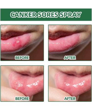 Ulcer Breath Sprays Mouth Ulcers Treatment Spray Ulcer Treatment Canker Sore Treatment Canker Relief Spray Herbal Mouth Spray Ulcer Pain Relief Spray Breath Spray for Bad Breath Mouth Freshener Spray - Buy Online on GoSupps.com