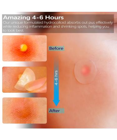 VonTeok Acne Pimple Patches (144 Patches) Ultra-Thin Hydrocolloid Stickers with Tea Tree Oil for Fast Redness Relief & Concealment of Zits Blemishes Spots - Buy Online on GoSupps.com