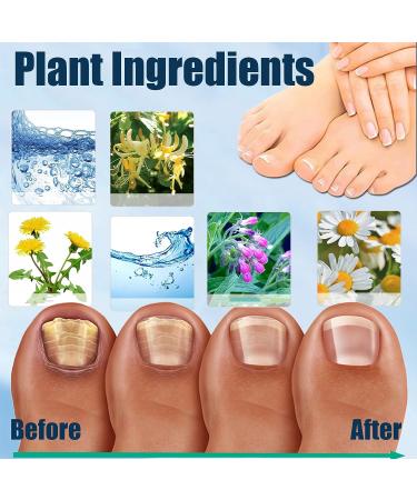 Extra Strength Toe Nail Repair Treatment for Thick, Cracked, Damaged, Discolored Yellow Nails - 30ml - Buy Online on GoSupps.com