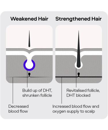 Sons Minoxidil 5% Hair Regrowth Solution for Men - Precision Application System - 1 Month Supply - Buy Online on GoSupps.com
