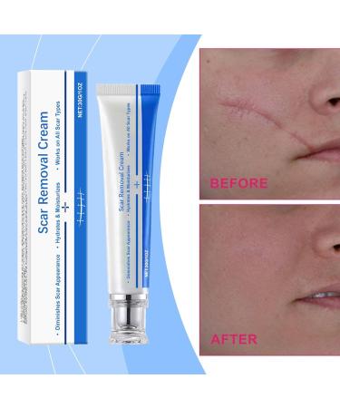 Scar Removal Fade Stretch Marks 30g Gel Reduces Stretch Marks Keloids Surgical Wounds Injuries Cesarean Section New and Old Scars - Buy Online on GoSupps.com