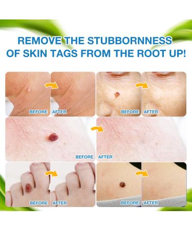 Ulensy Skin Tag Remover - Extra Strength Liquid for Fast, Pain-Free Skin Tag Removal - Natural Plant Extracts, No Scars - Easy Application (Natural Blue) - Buy Online on GoSupps.com
