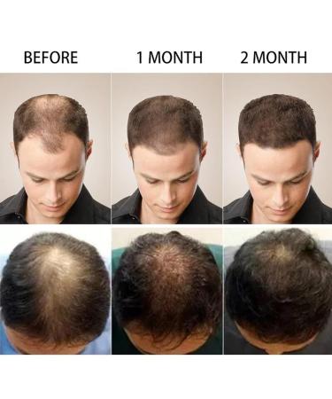 Savvy High Hair Growth Purc Oil - Hair Density Essential Oil Serum for Natural Regrowth, Anti-Frizz & Dry Hair Care - 2 pcs - Buy Online on GoSupps.com