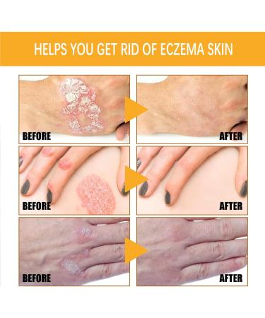 KOAHDE Psoriasis Professional Treatment Cream Bee Venom Psoriasis Treatment Cream Bee Venom Professional Treatment Cream Bee Venom Treatment Cream Bee Venom Topical Cream Bee Psoriasis Repair Cream - Buy Online on GoSupps.com