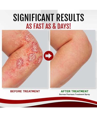 Dermax Psoriasis Treatment Spray Psoriasis Treatment Spray Kolmax Psoriasis Relief Spray Scalp Psoriasis Treatment Spray 30ml Psoriasis Treatment Spray (2 PCS) - Buy Online on GoSupps.com