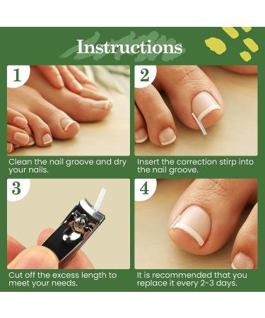 RMISODO 60-Piece Ingrown Toenail Corrector Strips - Professional Toenail Correction Patches for Curved Toenails - Paronychia Correction Pedicure Tool - Buy Online on GoSupps.com