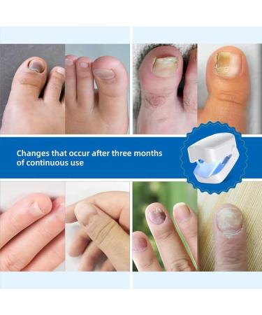 Anti Fungal Nail Treatment Device Anti Fungal Laser Nail Fungus Laser Treatment for Damaged Discolored Thick Toenails & Fingernails 7-Minute Home Treatment for Hand Toenail Fungal Infections - Buy Online on GoSupps.com