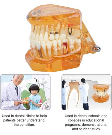 Dpofirs Orange Dental Model - Removable Teaching Tool for Dental Programs Adult Tooth Demonstration & Dental Implants - Buy Online on GoSupps.com