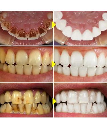 Tooth whitening essence tooth restoration and spot removal liquid professional tooth whitening liquid coffee tea stains and cola to clean yellow teeth (1 piece *10 cotton swabs) - Buy Online on GoSupps.com