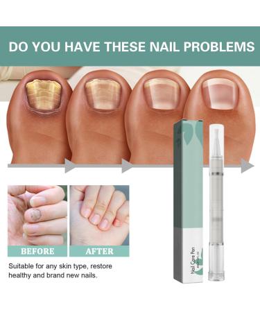 4-Piece Nail Care Pen Set with Tea Tree Oil Vitamin E & Aloe Vera - Well-Groomed Fingernails & Toenails - Includes Nail File - Green - Buy Online on GoSupps.com