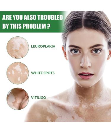 Vitiligo Care Set: Fix Revitalize Elixir & Soothing Moisturizer Cream - Reduce White Spots on Body - 2pcs - Buy Online on GoSupps.com