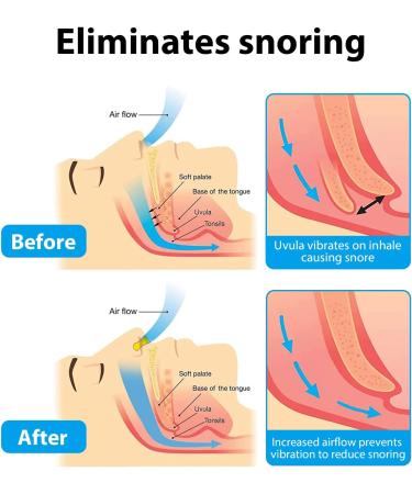 8pcs Magnetic Anti Snoring Devices - Nasal Dilator Clips for Men and Women | Stop Snoring Aid for Better Breathing and Comfortable Sleep - Buy Online on GoSupps.com