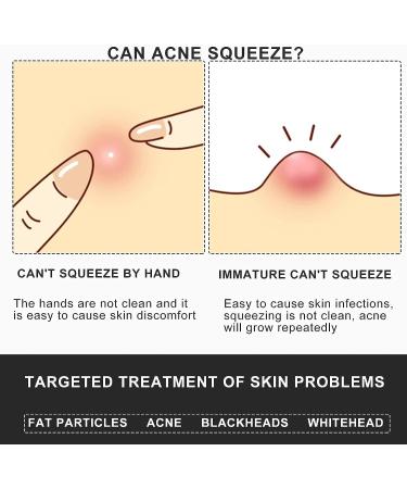 MUZE Professional Facial Milia Removal Tweezers - Precision Nose Tool for Blackhead & Pimple Removal - Buy Online on GoSupps.com