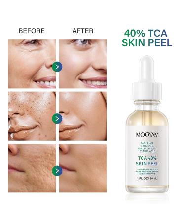 40% Citric Acid Peeling Serum | Chemical Peel for Face, Skin Exfoliant for Dark Spots & Acne | 30ml/1 Fl oz - Buy Online on GoSupps.com