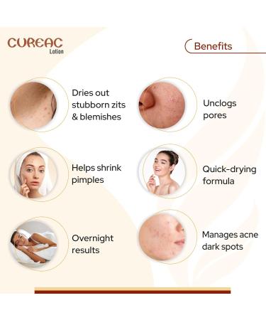 Calamine Acne Drying Lotion Overnight Results for Teens & Adults-70 ml - Buy Online on GoSupps.com