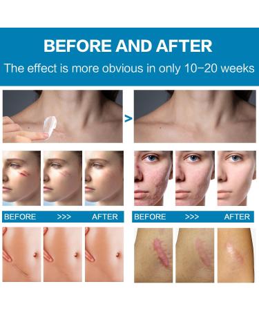 Scar Removal Cream - Repair & Moisturize Old/New Scars, for Male/Female, Surgery/Scald/Burns - 1.85 FL OZ - Buy Online on GoSupps.com