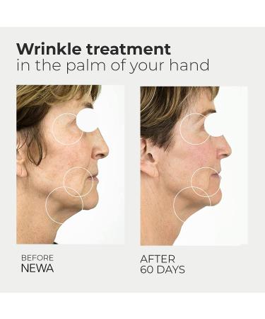 NEWA RF Wrinkle Reduction Device - FDA Cleared Skincare Tool for Facial Tightening | Boosts Collagen, Reduces Wrinkles | 1 Month Gel Supply | Ivory Classic - Buy Online on GoSupps.com