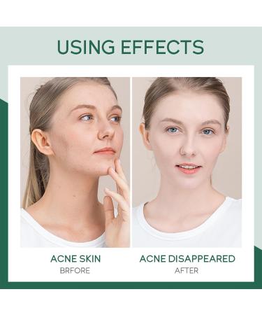 Acne Skincare Set Gifts for Teen Girls | Tea Tree Oil Control Kit - Toner Serum Gel | Travel-Friendly Facial Care - Buy Online on GoSupps.com