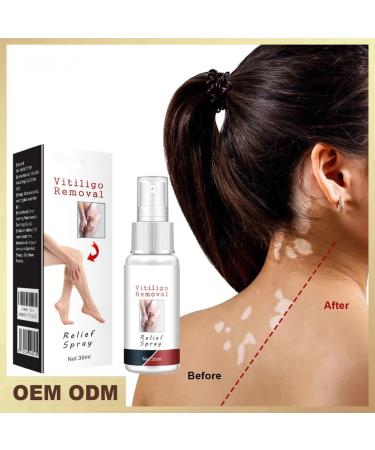Vitiligo Removal Relief Spray - Reduces White Spots on Skin - 3pcs - Buy Online on GoSupps.com