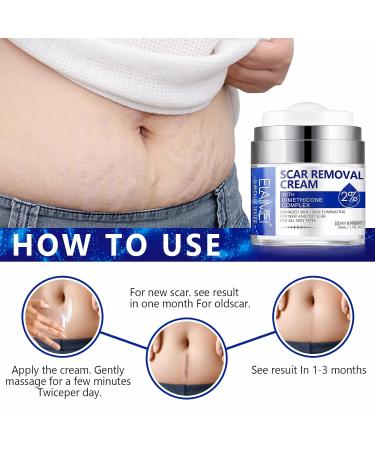 Advanced Scar Removal Cream - Effective Treatment for Surgical Acne C-Section Burns & Stretch Marks - Old & New Scars - Buy Online on GoSupps.com