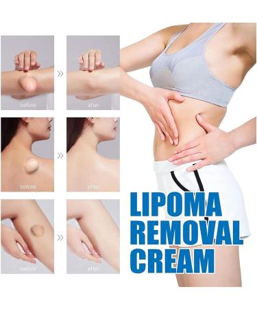 GeRRiT Lipoma Removal Cream Soothing Ointment for Lipoma Natural Lipoma Removal Cream Anti-Swelling Lymphatic Detox Breastfeeding Cream for Skin Care - Buy Online on GoSupps.com