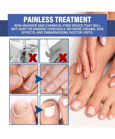 NailPro Nail Fungus LED Light Therapy Device Nail Fungus Laser Nail Fungus Treatment Home Use Nail-Fungus Remover for Toenail Fingernails & Onychomycosis (A01) - Buy Online on GoSupps.com