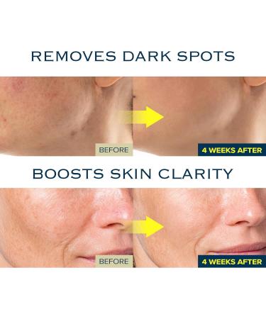 MIMUMIMU Dark Spot Remover Serum for Face | Korean Clinic Skincare - Thioctic Acid 0.01% & Niacinamide 5% | Spot Treatment for Melasma Hyperpigmentation Discoloration Acne Scars | 30ml/1.01 fl.oz 1pc - Buy Online on GoSupps.com