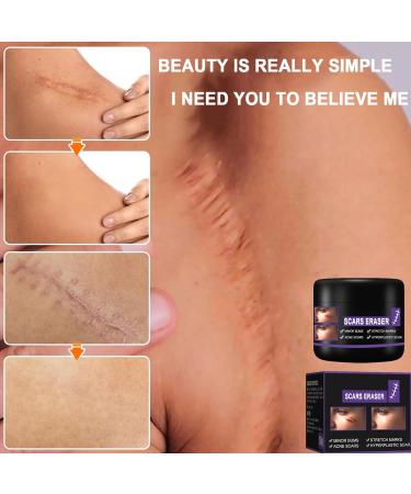 Scar Removal Cream 50ml - C-Section Skin Repair, Stretch Marks & Acne Surgery Treatment - Buy Online on GoSupps.com