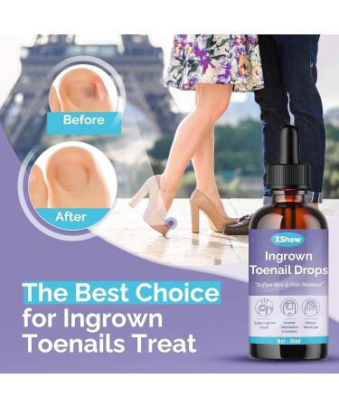 Ingrown Toenail Treatment & Pain Reliever - Softens for Easy Trimming | 30ml - Buy Online on GoSupps.com