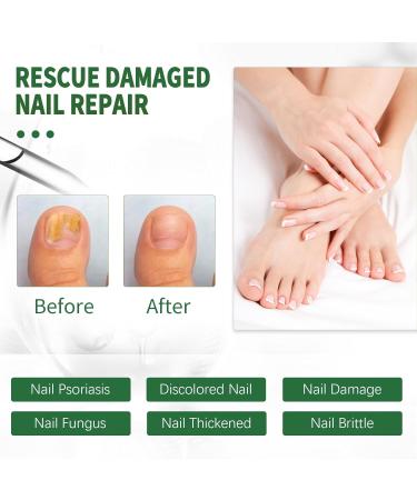 Extra Strength Toenail Fungus Treatment - 30ml | Effective Nail Fungus Solution for Thick Broken & Discolored Nails - Fast Shipping Internationally - Buy Online on GoSupps.com