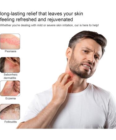 Heat Rash Cream  Eczema  Hand Foot Treat  Tinea Versicolor  Itchy Feet  Butt  Anal Itch  Psoriasis  Scalp Dandruff  Bee Sting  Bites  Boil Cyst  Armpit  Adults Kids  Hidradenitis Suppurativa Treat - Buy Online on GoSupps.com